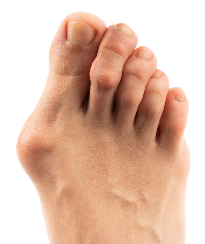 Hammertoes – Golden Triangle Foot & Ankle Specialists